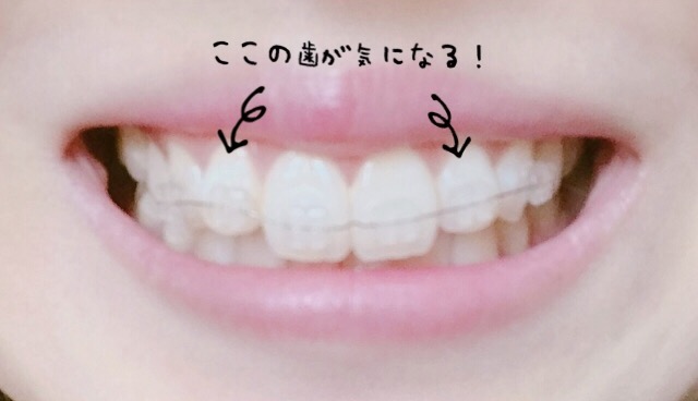 再矯正した歯の気になるところ