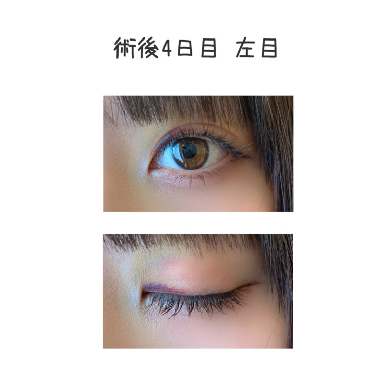 二重整形埋没法のビフォーアフター4日目