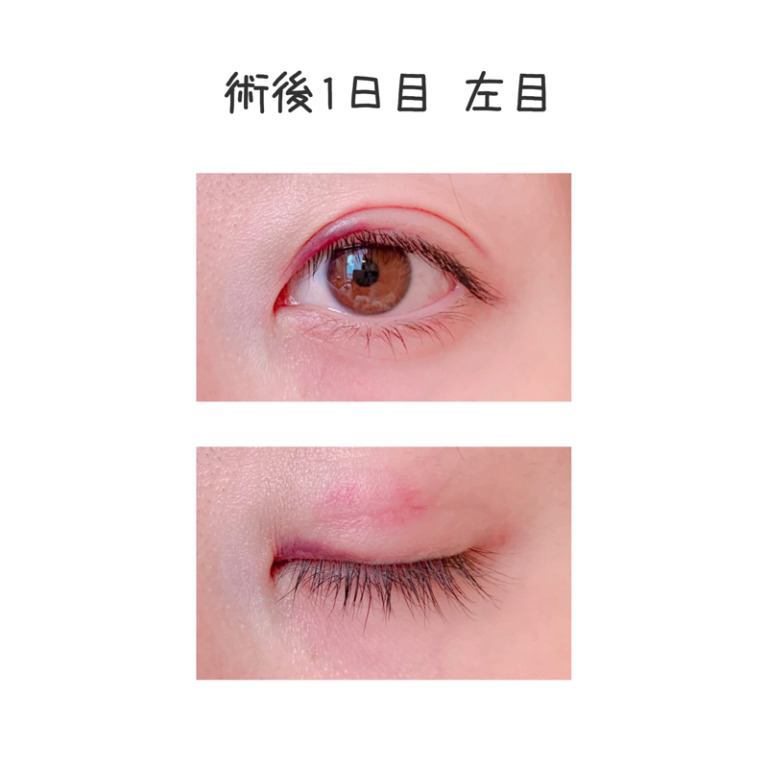 二重整形埋没法のビフォーアフター1日目