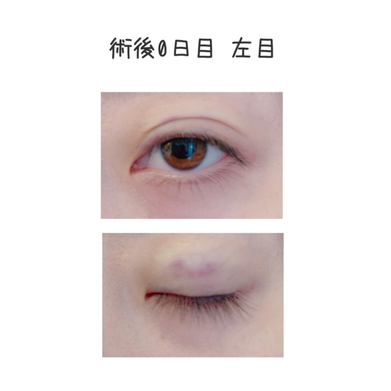 二重整形埋没法のビフォーアフター1日目
