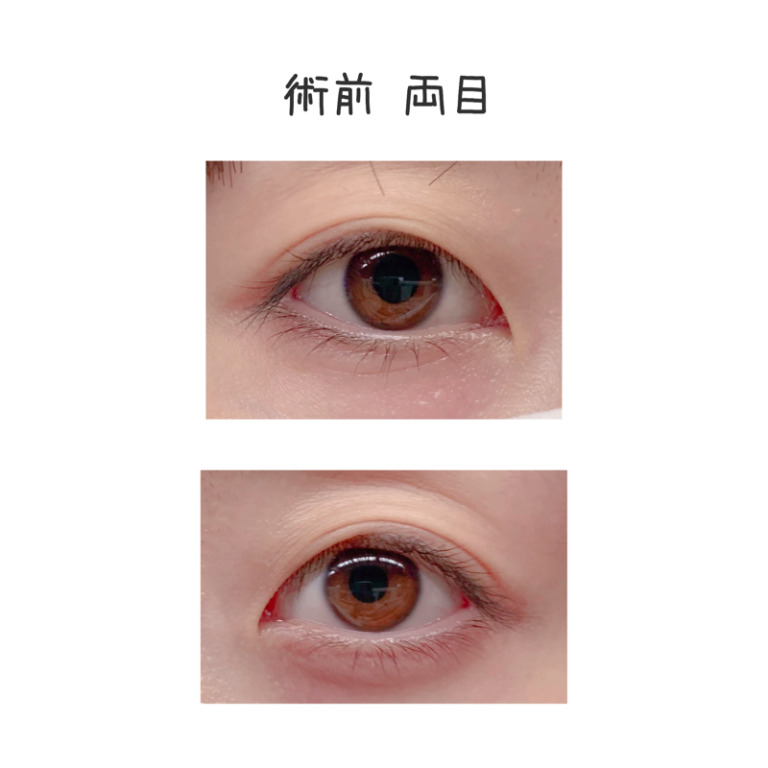 二重整形埋没法のビフォーアフター