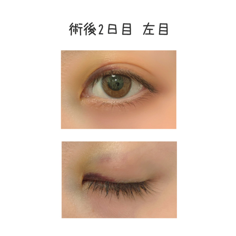 二重整形埋没法のビフォーアフター2日目
