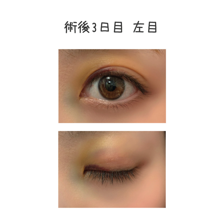 二重整形埋没法のビフォーアフター3日目